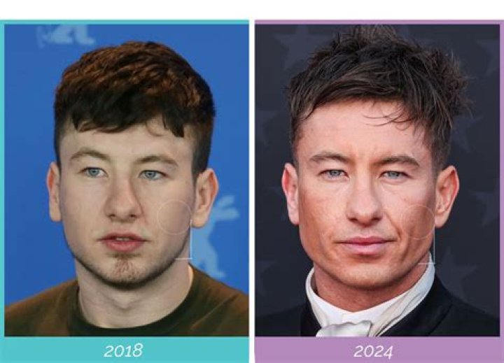 Barry Keoghan's Plastic Surgery: A Look At His Transformation