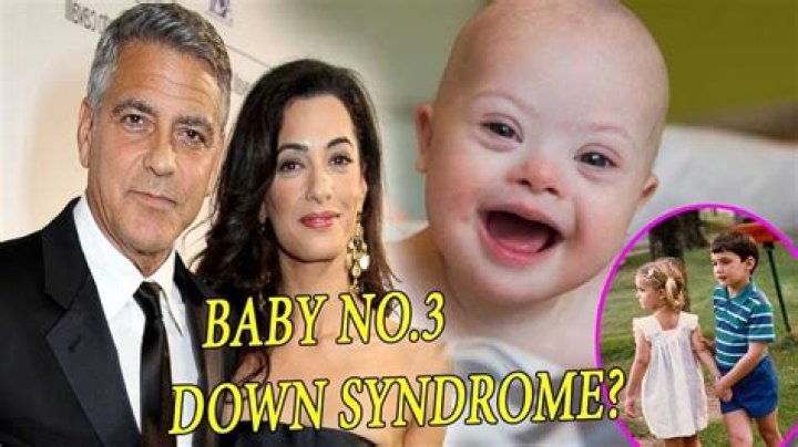 George Clooney's Child: Understanding Down Syndrome