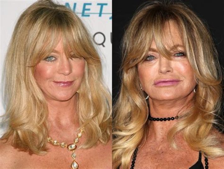 Did Goldie Hawn Resort To Plastic Surgery? The Answers You Seek