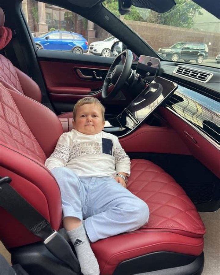 What Is Hasbulla's Genetic Condition? A Medical Explanation