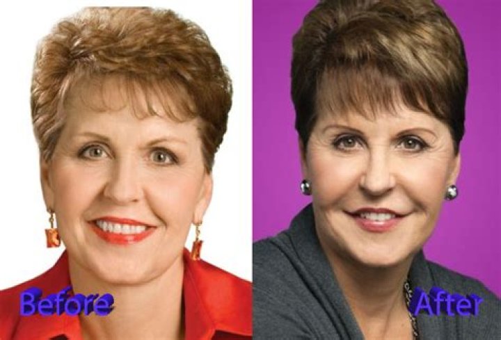 The Ultimate Guide To Joyce Meyer's Facelift: Before And After