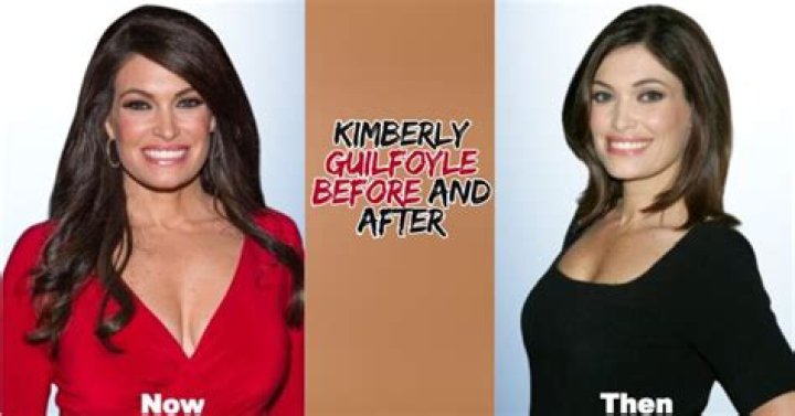 Kimberly Guilfoyle's Transformation: A Before And After Botox Comparison