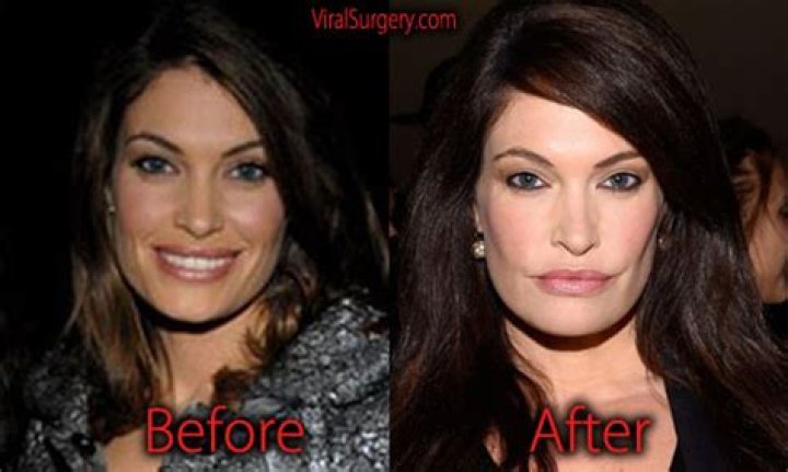 Exploring Kimberly Guilfoyle Before Botox: A Journey Through Time