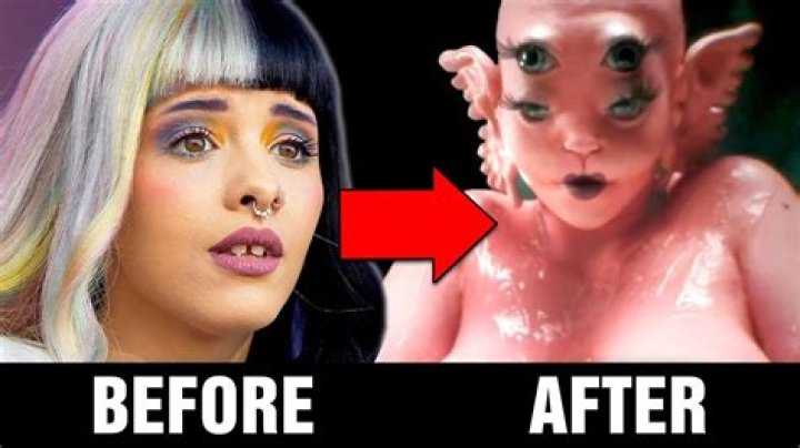 Melanie Martinez's Plastic Surgery Journey