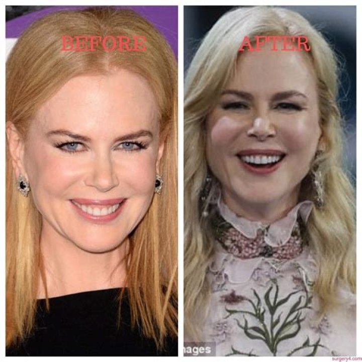 Unmasking The Transformation: Nicole Kidman's Journey With Plastic Surgery
