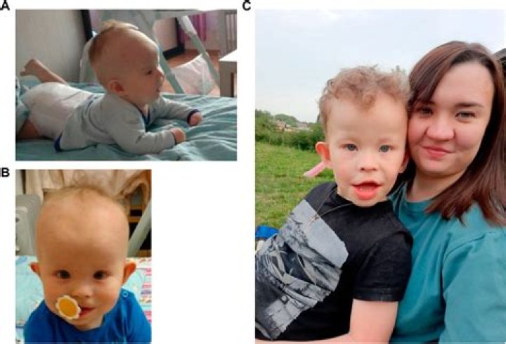 Definitive Guide To Pallister-W Syndrome Rosas