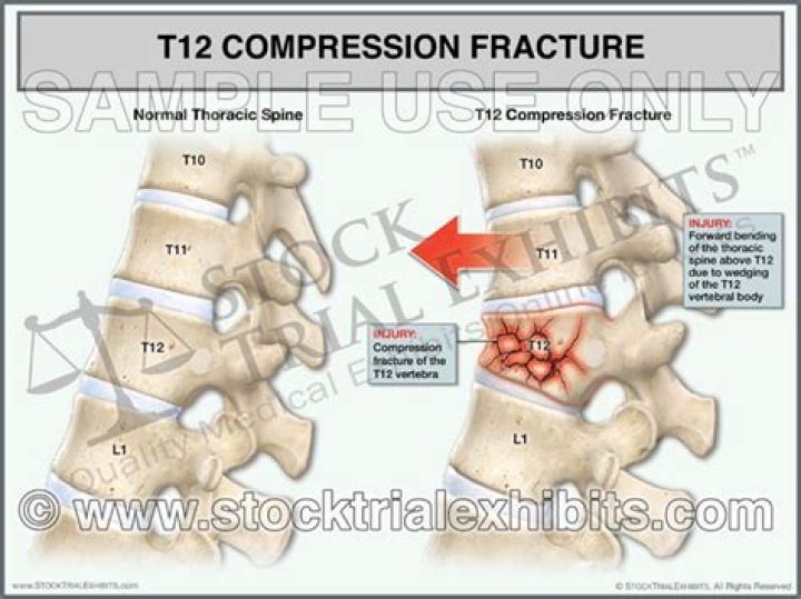 Ultimate Guide To Understanding T12 Fractures